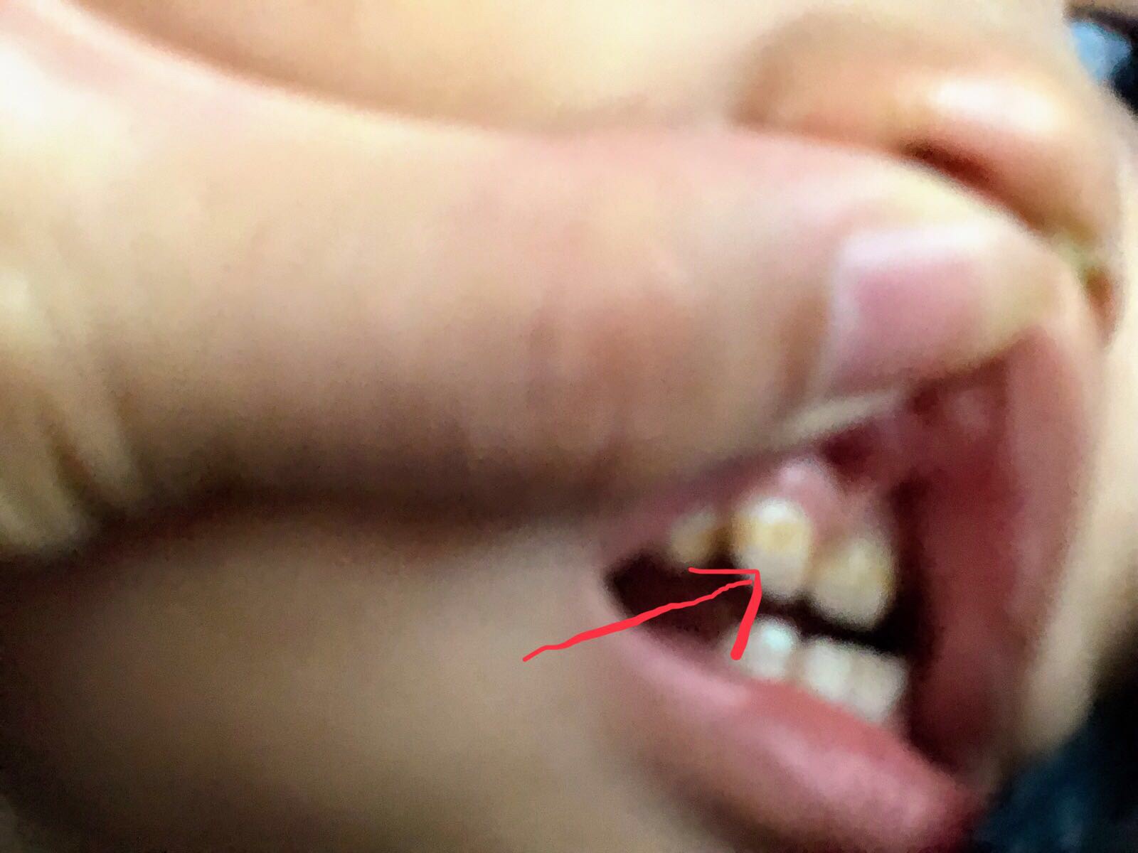 1歳児の虫歯
